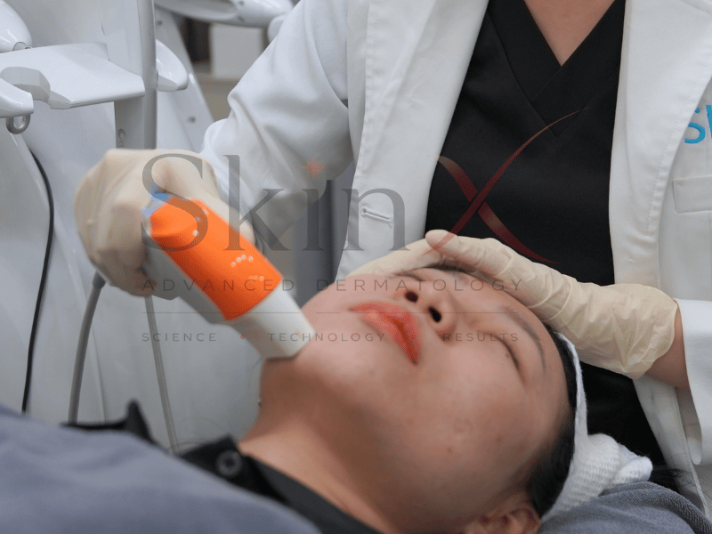 Ultraformer MPT giải quyết tốt tình trạng mỡ nọng cằm